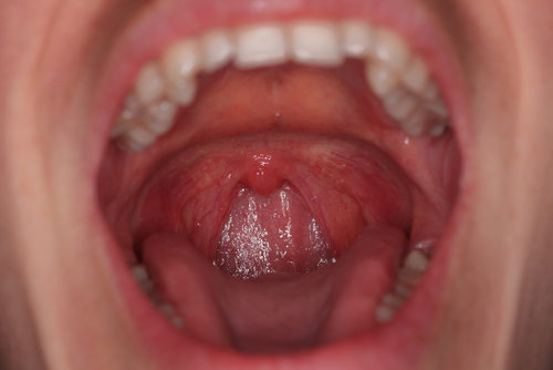 Virus de papiloma humano en cabeza y cuello